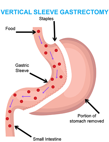 VERTICAL SLEEVE GASTRECTOMY Diagram
FOOD
STAPLES
GASTRIC SLEEVE
SMALL INTESTINE
PORTION OF STOMACH REMOVED